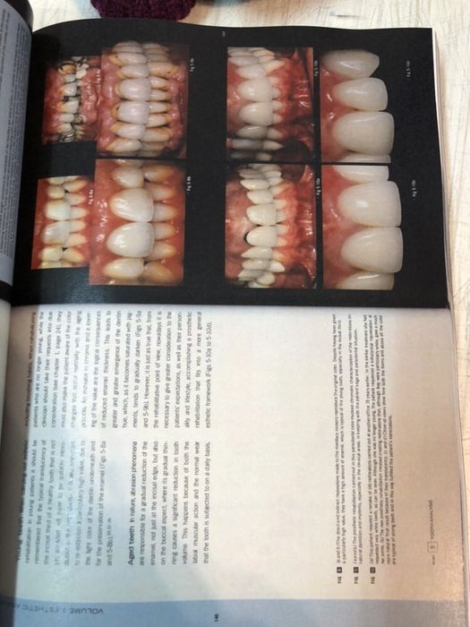 Esthetic Rehabilitation in Fixed Prosthodontics, Volume 1 & 2 FRADEANI