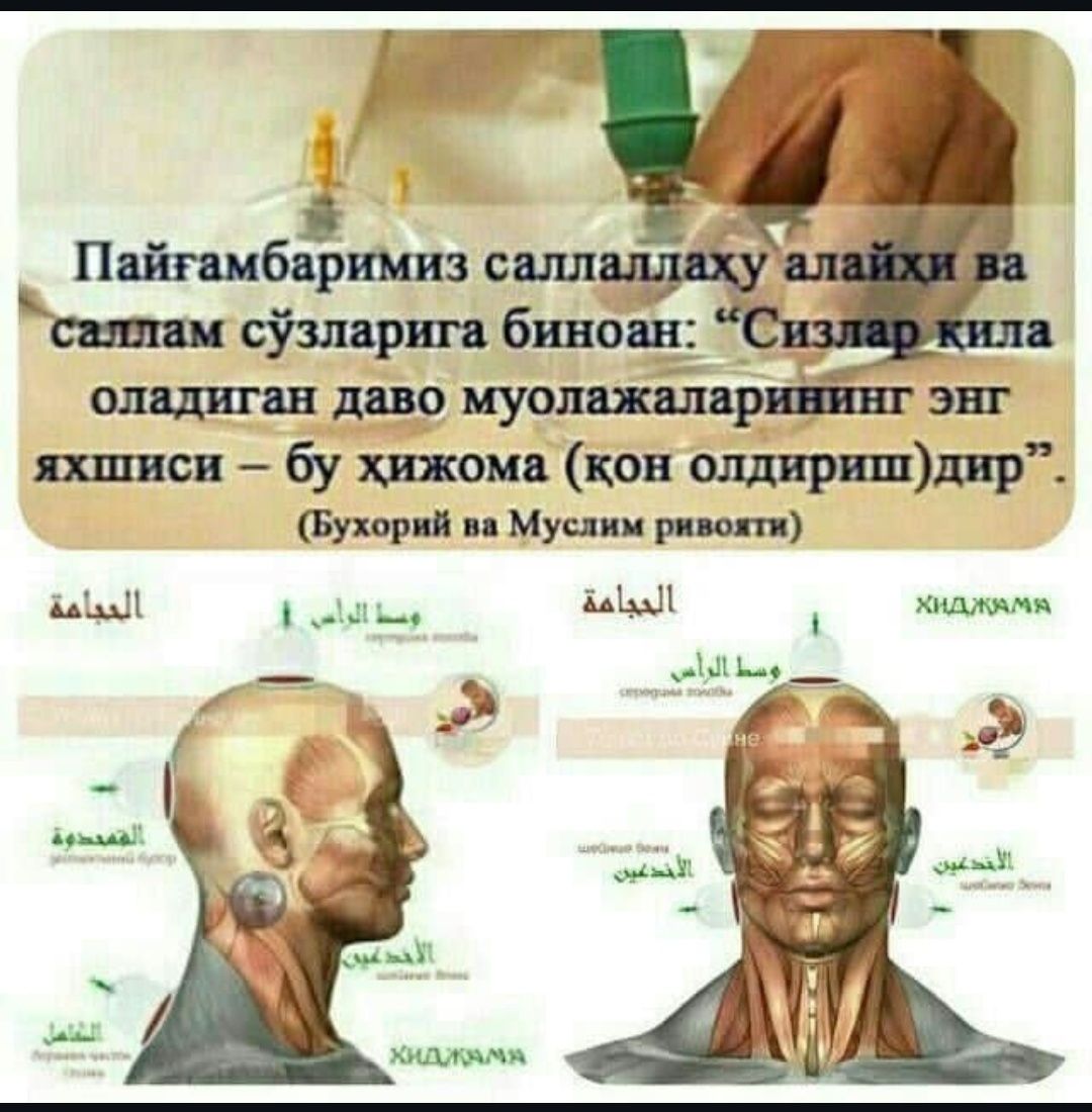 Izsiz hijama 72 xil kasallikning davosi
