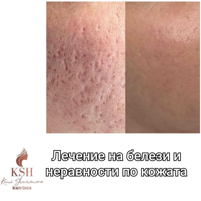 Терапии за лице и тяло, HIFU 7d,RF Микронидлинг,Лазер,Tecar Rf Пловдив