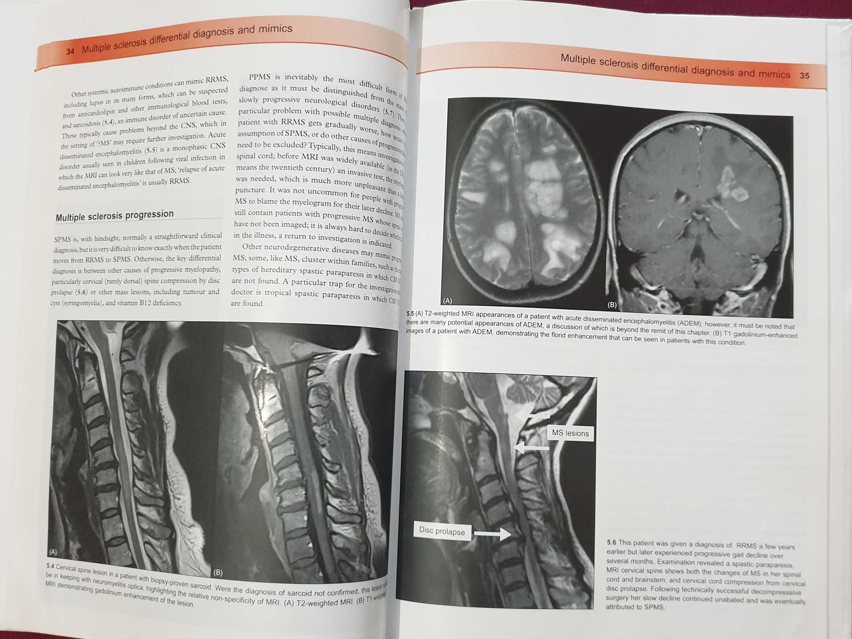 Множествена склероза - визуален справочник / Multiple Sclerosis