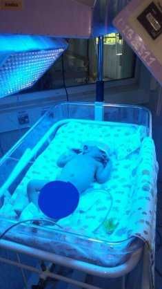 Fotolampa va BILIRUBIN miqdorini qonsiz aniqlash 50000