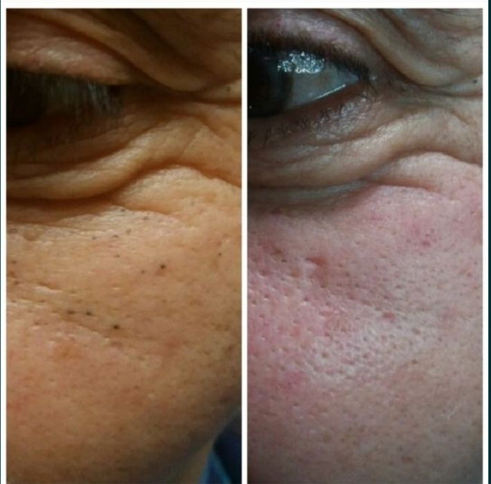 Чистка лица механическая,ультрозуковая омоложение, пилинг, массаж лица