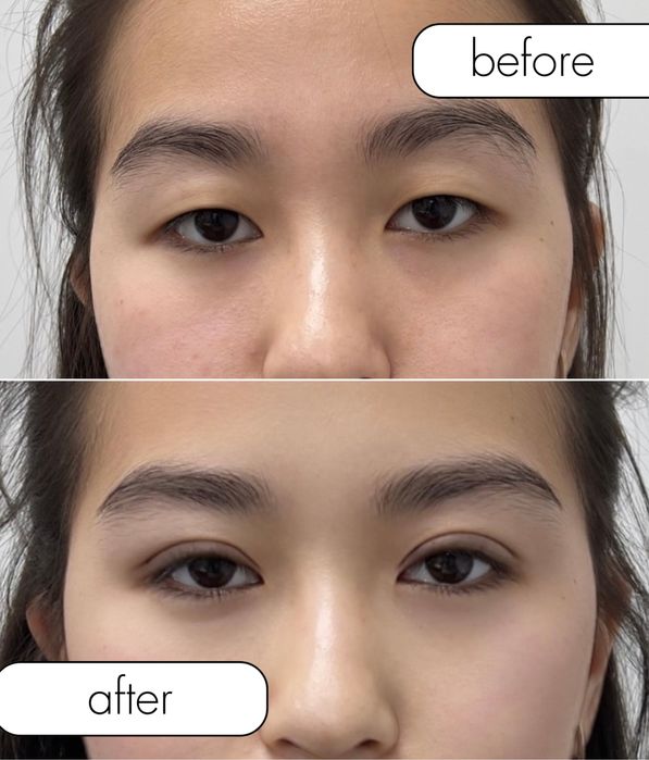 НИТЕВАЯ блефаропластика сангапруи