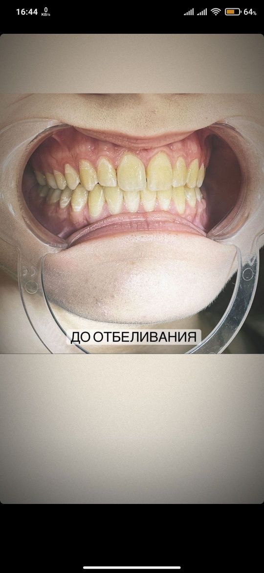Отбеливание зубов системой Zoom4