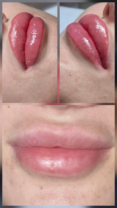 Remodelare nas și buze