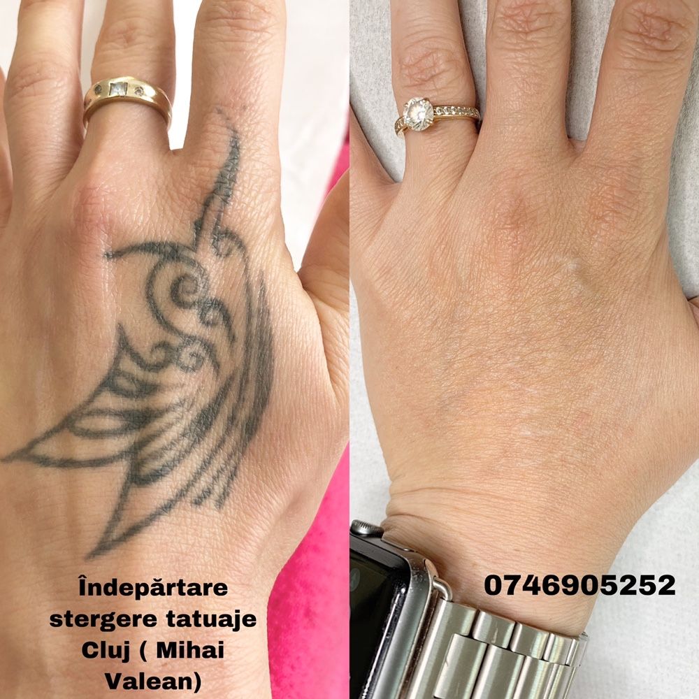 Tatuaj cosmetic , Microblading si Eliminare Tatuaje cu Laser