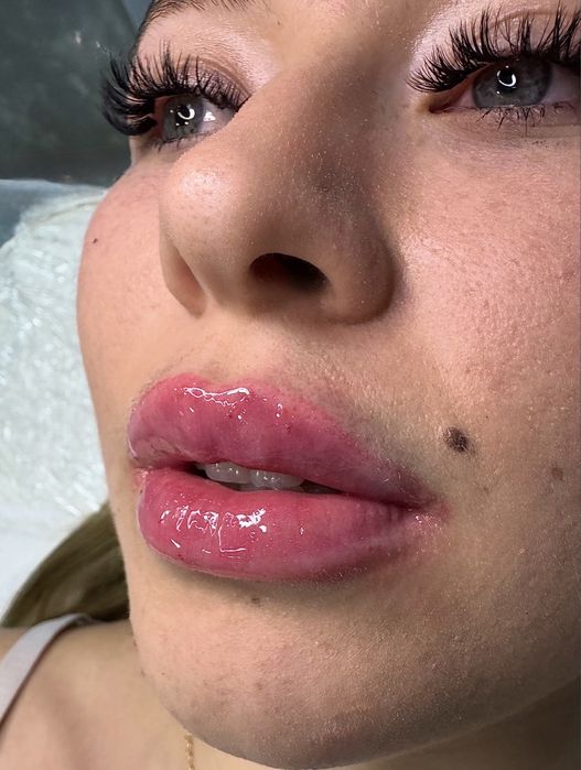 Augmentare buze,menton,riduri