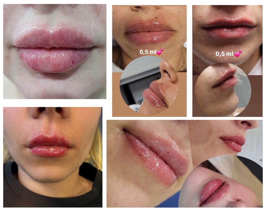 Augmentare buze cu acid hialuronic, lipoliza si epilare cu ceara