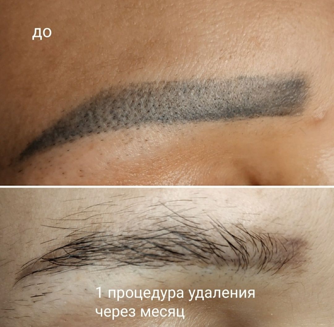 Удаление татуажа татуировки ремувер лазер брови губы стрелки