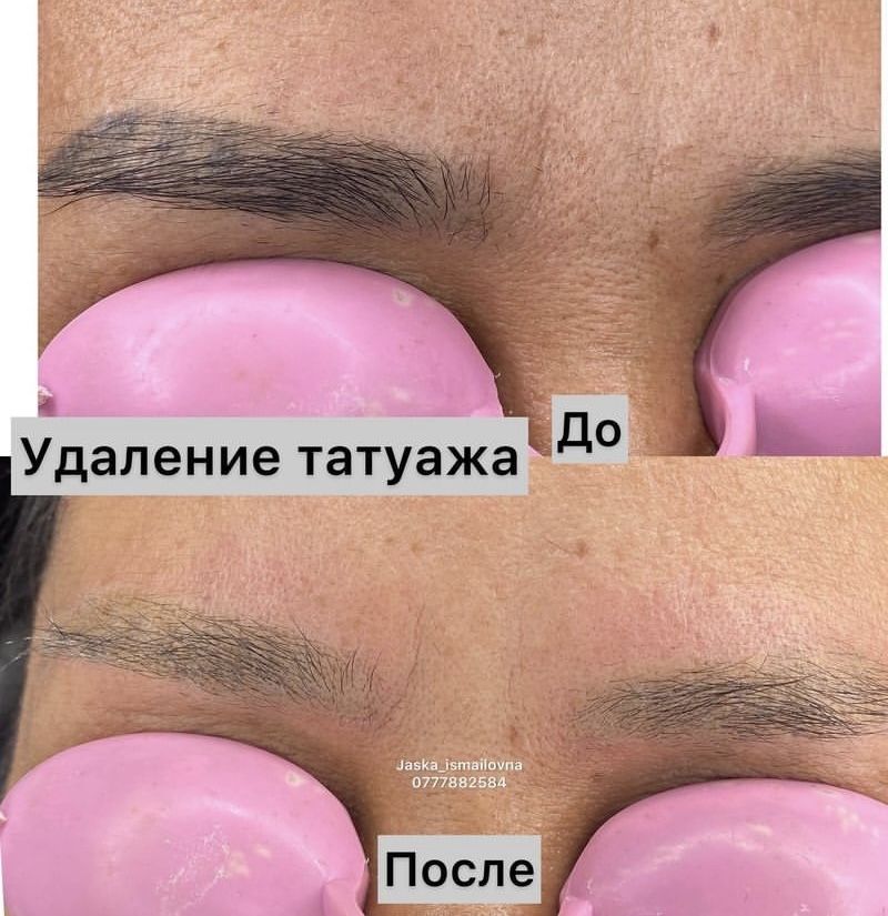 Удаление татуажа