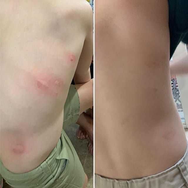 Bug Bite Thing - за след ухапване от комари, спира подуване и сърбеж