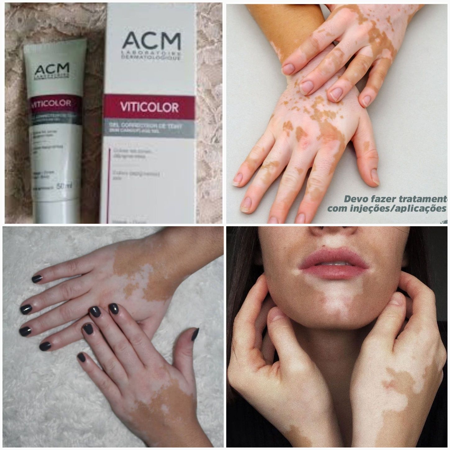 viticolor vitiligo. витиколор. Франция. БАД