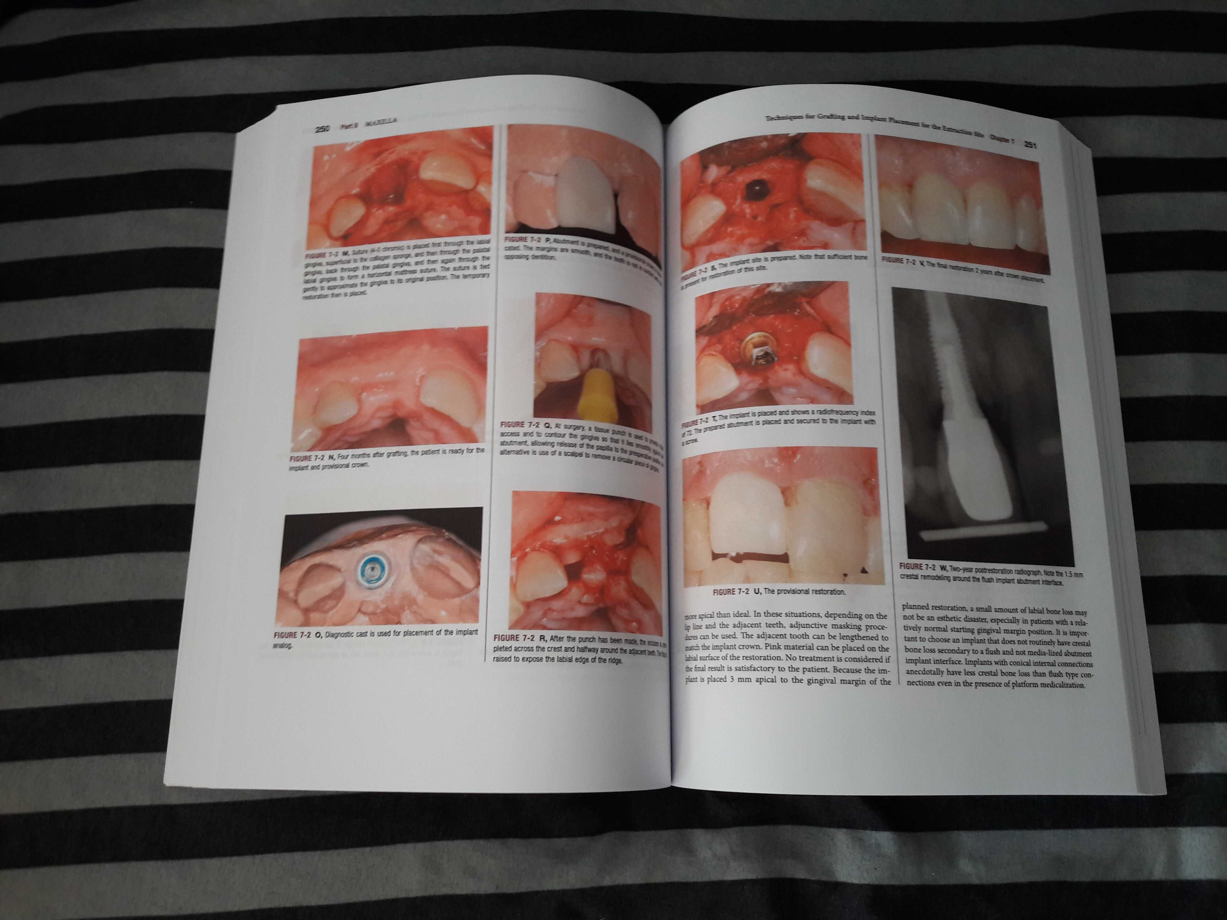 Dental Implant Complications, Stuart J. Froum Edition 2 - 2016