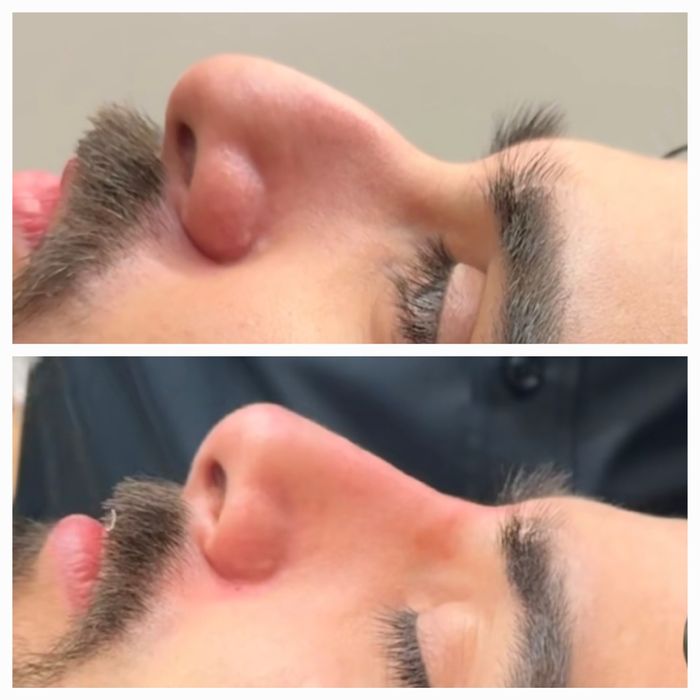 Remodelare nas și buze