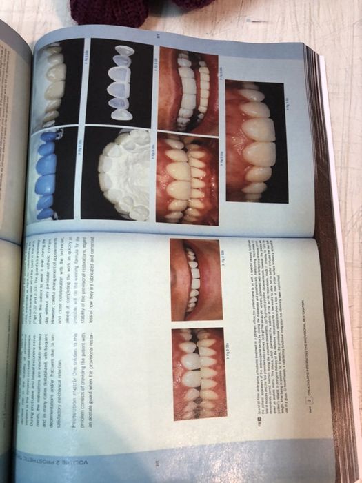 Esthetic Rehabilitation in Fixed Prosthodontics, Volume 1 & 2 FRADEANI