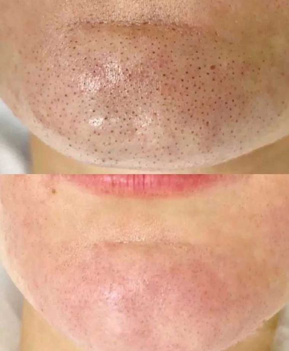 Чистка лица, косметолог