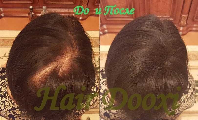 Hair Dooxi-От выпадения и для роста волос!