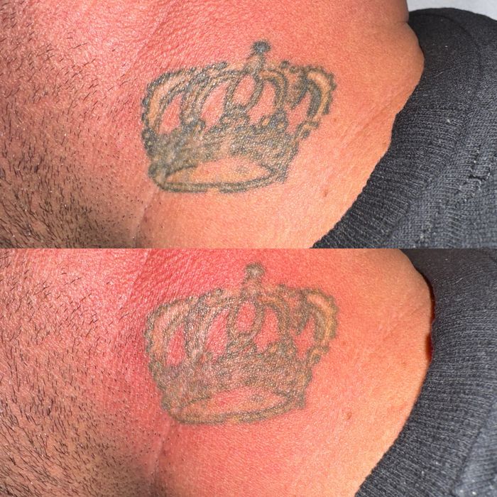 Stergere tatuaje cu laser nd:Yag