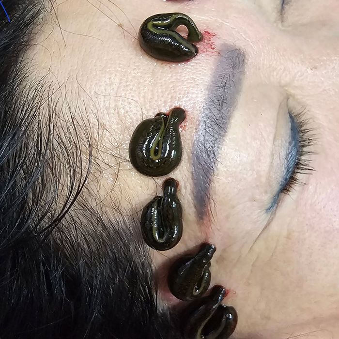 Хиджама. 30 лет стаж.. Пиявки,  Врач. Акция