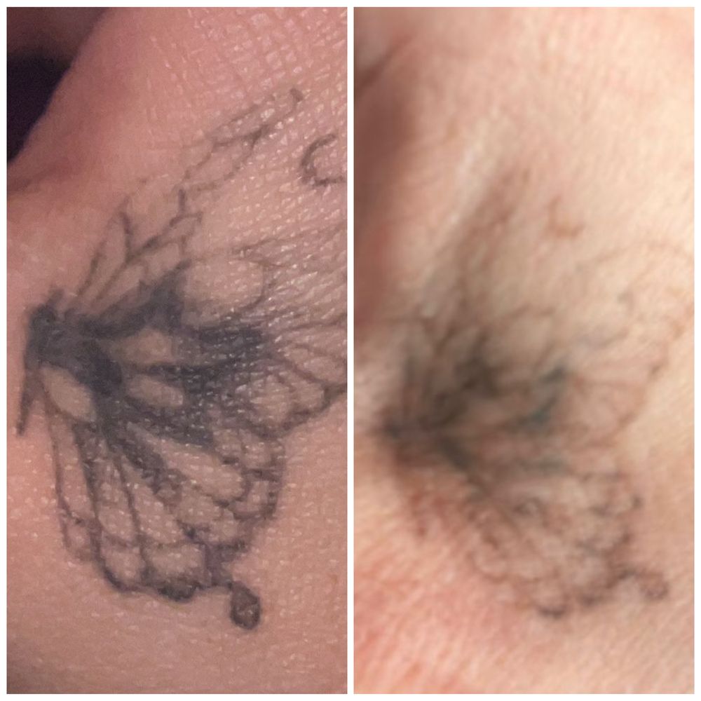 Arad-Eliminare tatuaj cu laser, preturi de la 100 ron