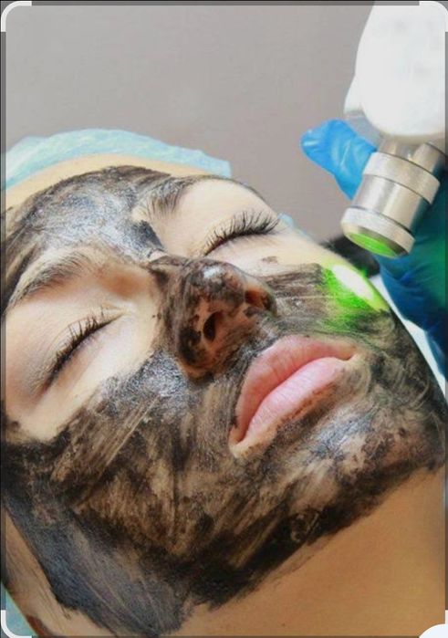 Карбоновый пилинг лица.