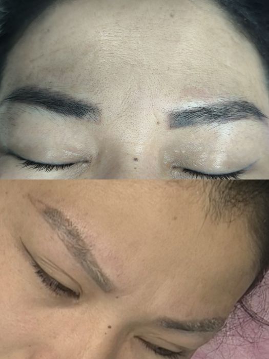 Лазерное удаление татуажа и лазерная эпиляция