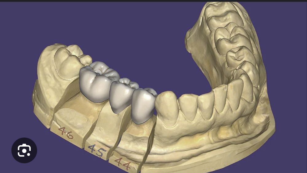 Exocad 3.2/Milbox/hyperdent/etc