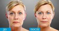 Smas lifting - ультрозвуковая подтяжка лица у косметолога