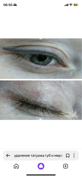 Удаления Татуажа .Брови ,Губы .Цена 8000 тыс .