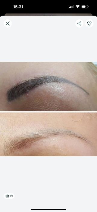 Эпиляция и удаление тату